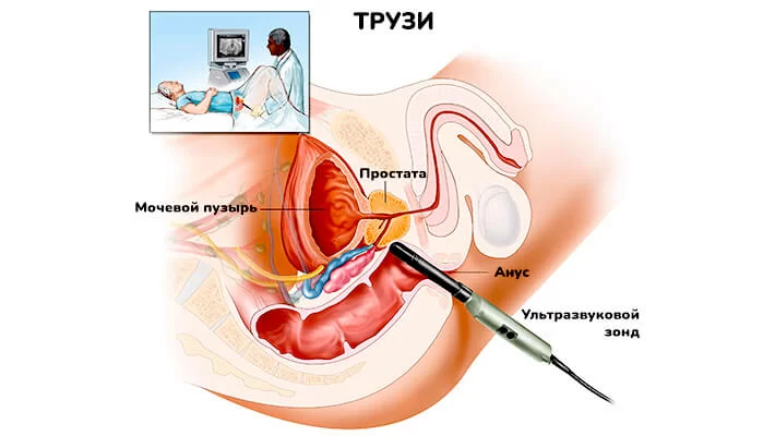 Как делают узи простаты