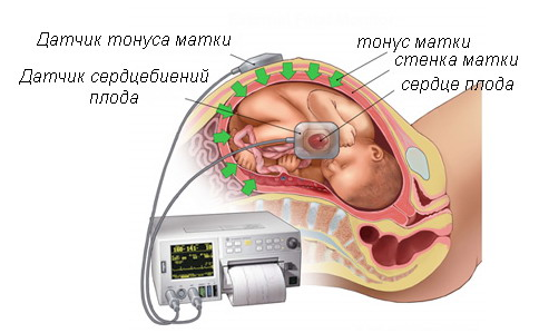 Кардиотокография плода что это такое