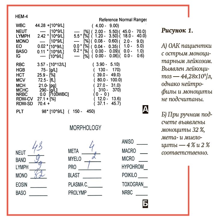 Лейкоз как определить по анализу крови