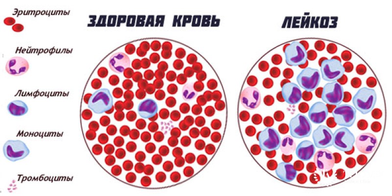 Лимфолейкоз это что