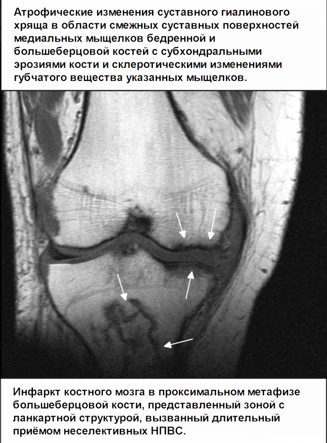 Мрт коленного сустава расшифровка