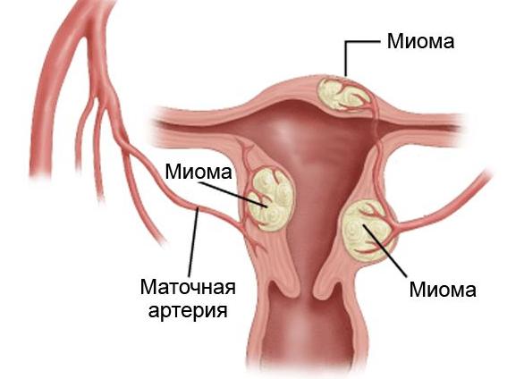 Миома матки фотографии