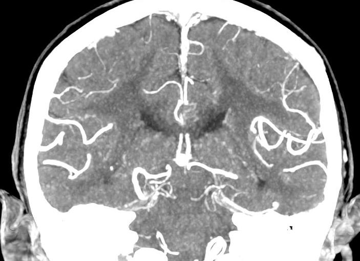 Кт головного мозга с контрастированием