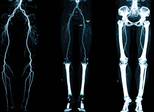 Кт ангиография сосудов нижних конечностей