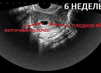 Когда виден эмбрион в плодном яйце на узи