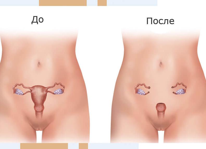 Кисты яичников после удаления матки Кисты яичников после удаления матки