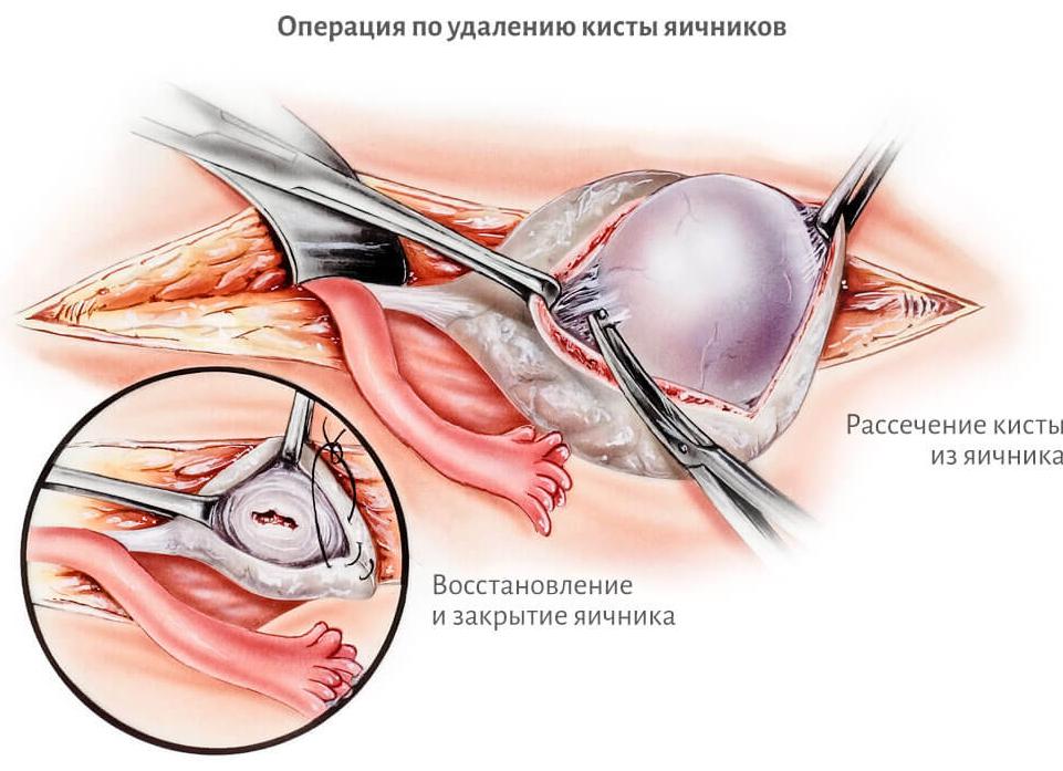 Киста яичника после операции