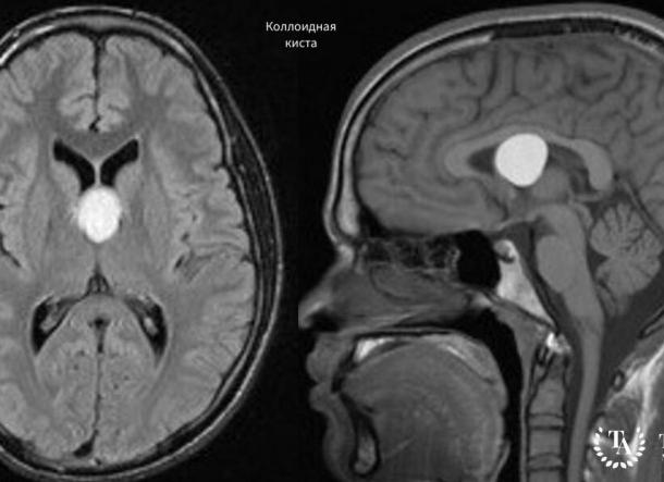 Киста в головном мозге у ребенка