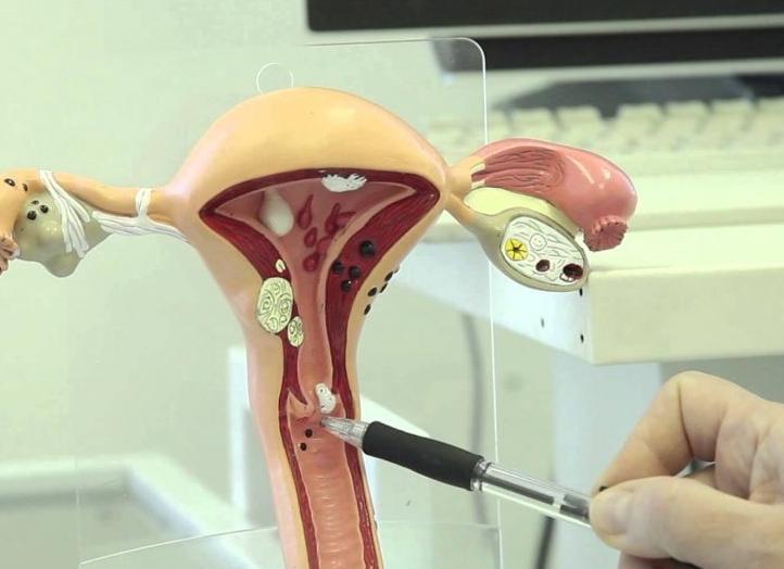 Киста эндометрия что это такое