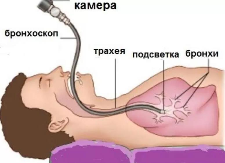 Как делают бронхоскопию бронхов Как делают бронхоскопию бронхов