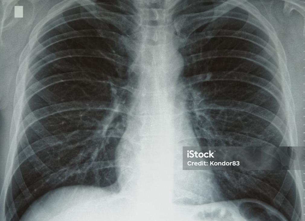 Фото здоровых легких на рентгене