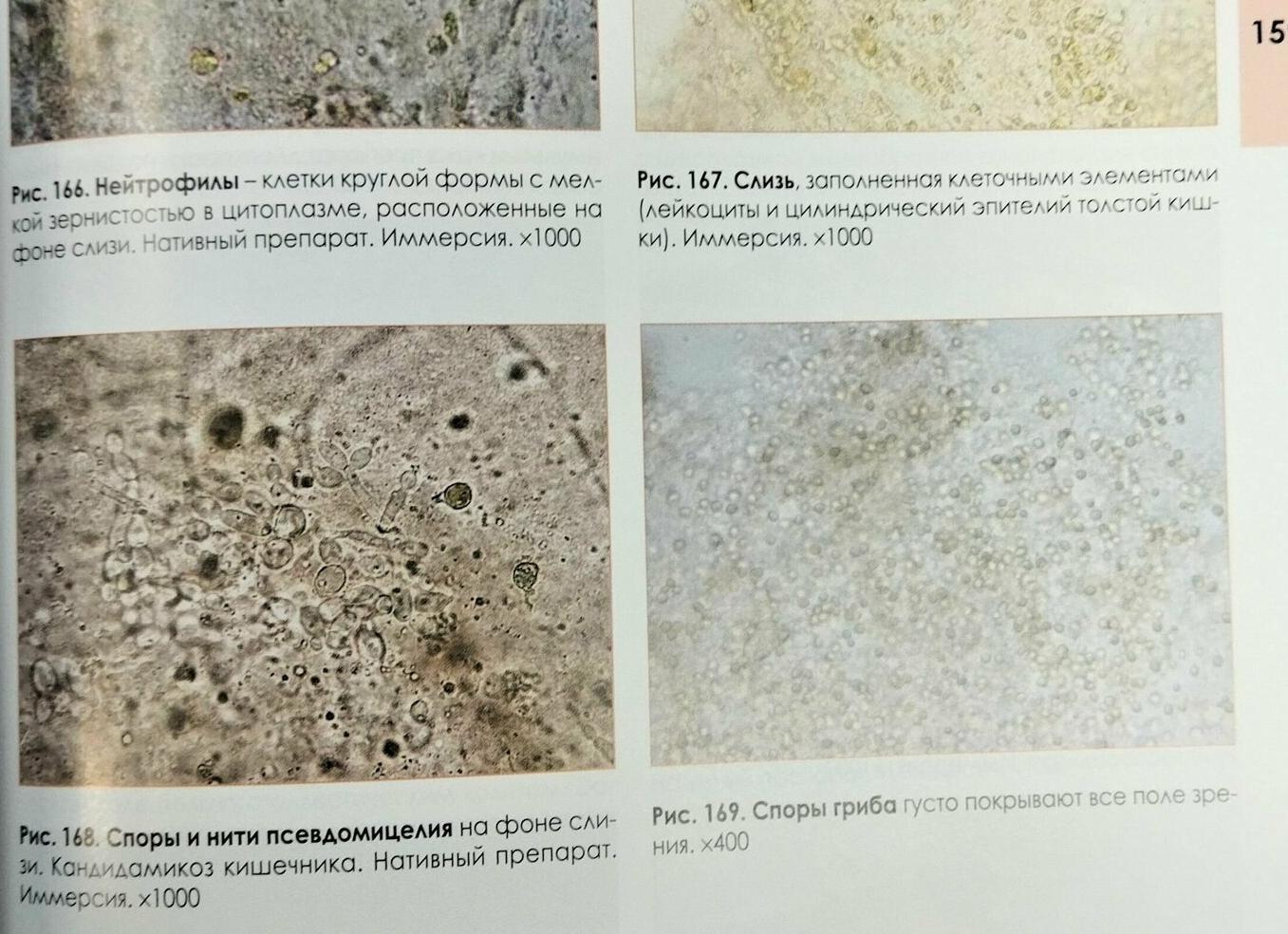 Эпителий в кале