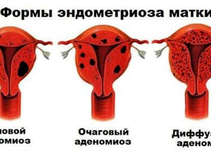Диффузные изменения эндометрия что это такое