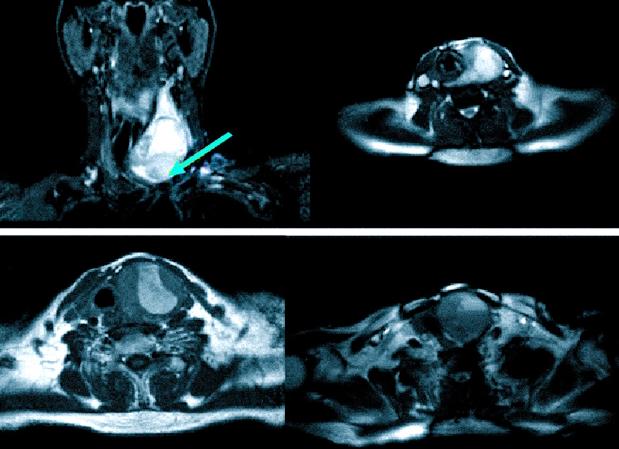 Что показывает мрт щитовидки
