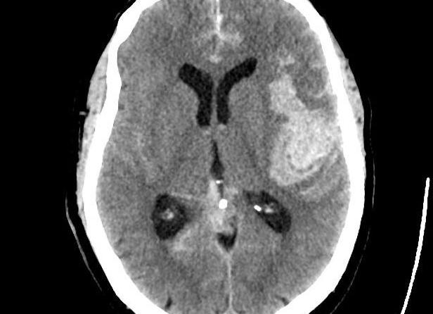 Что показывает кт головного мозга без контраста
