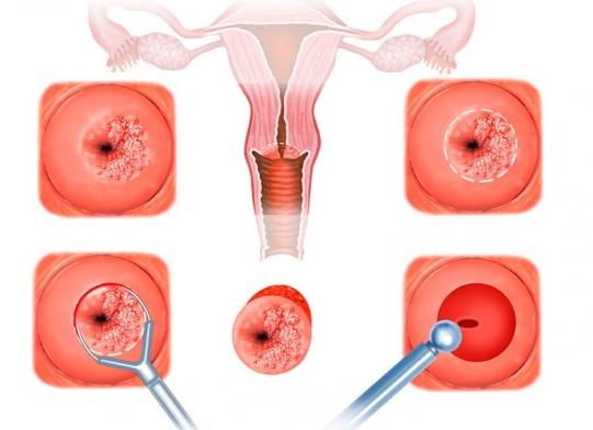 Биопсия шейки матки петлевая Биопсия шейки матки петлевая