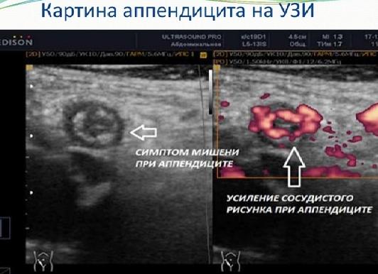 Аппендицит узи брюшной полости
