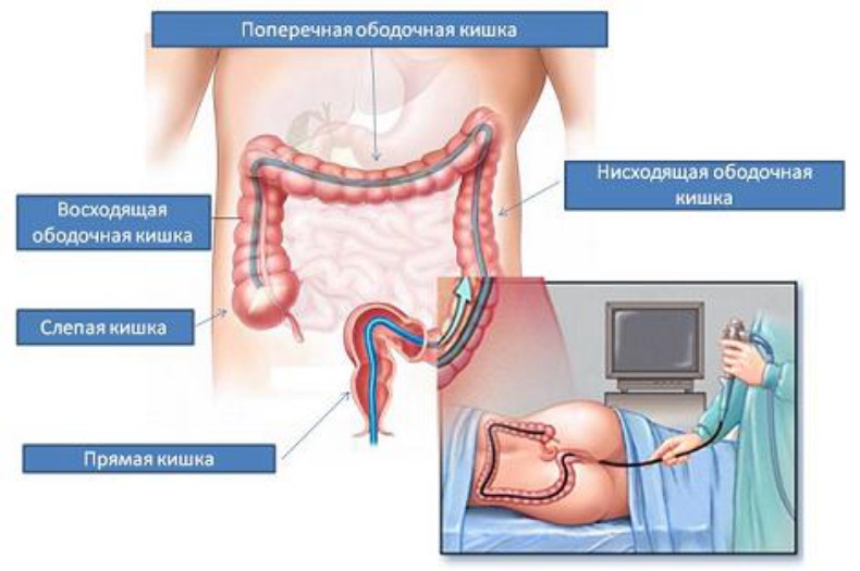 Как проверяют прямую кишку