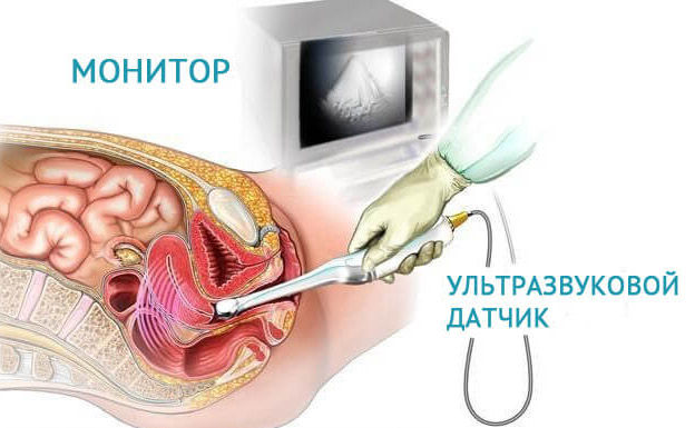 Как выглядит матка на узи