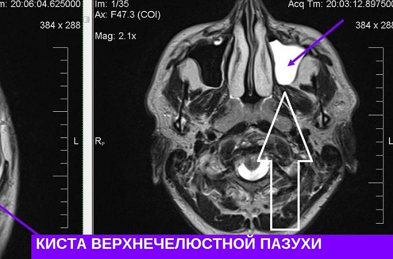 Киста правой верхнечелюстной пазухи головного мозга