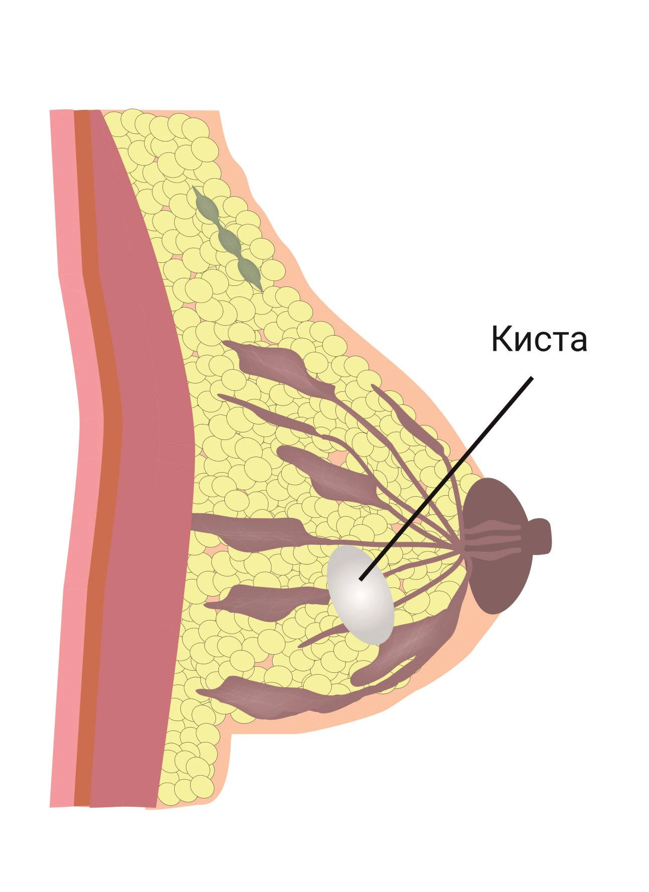 Киста в грудной железе что делать