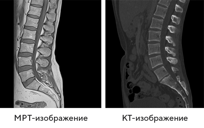 Компьютерная томография поясничного отдела позвоночника
