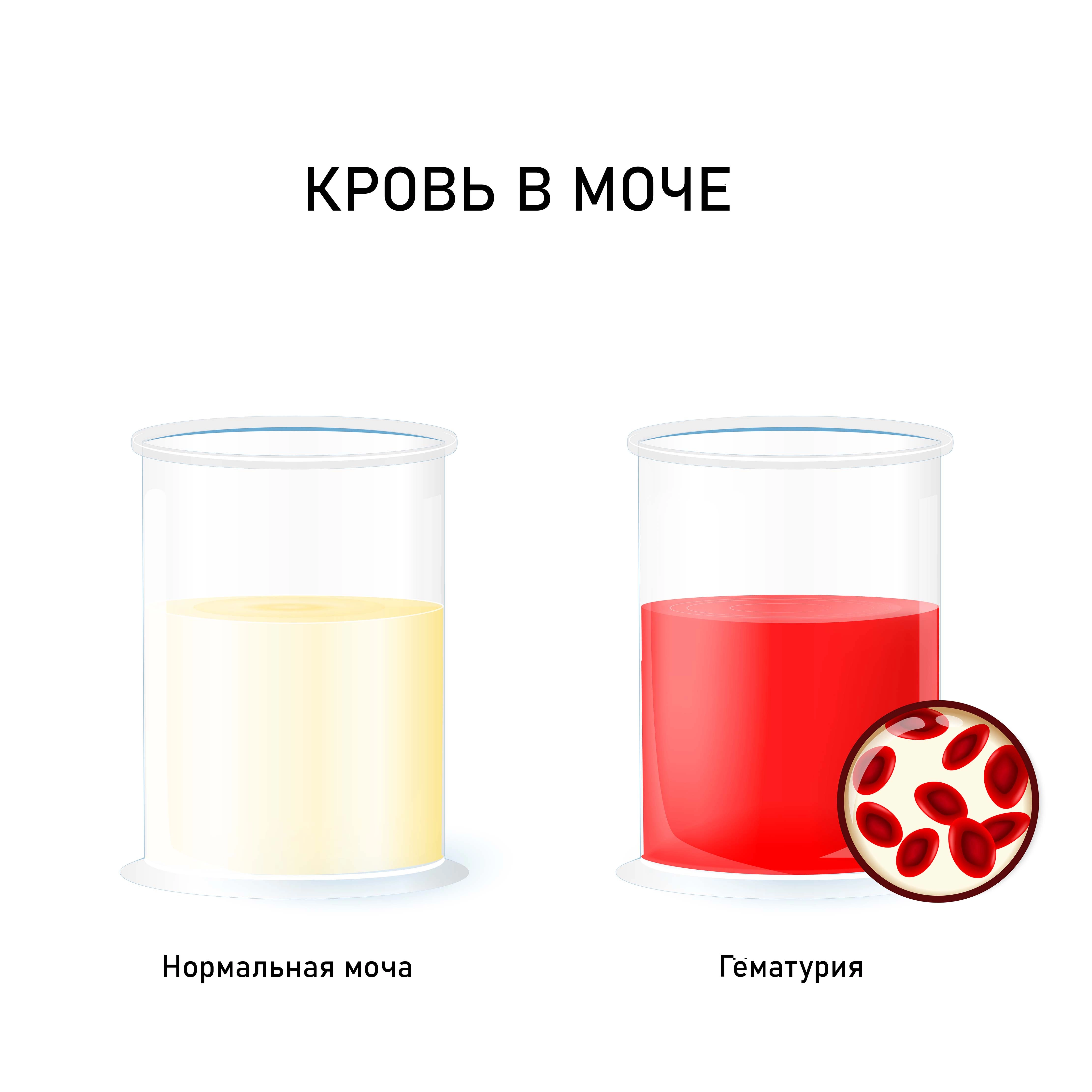 Красноватая моча у женщин