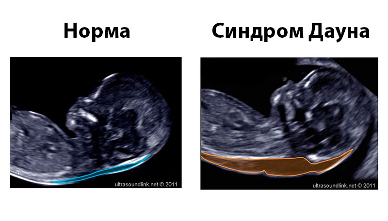 Можно ли определить синдром дауна по узи