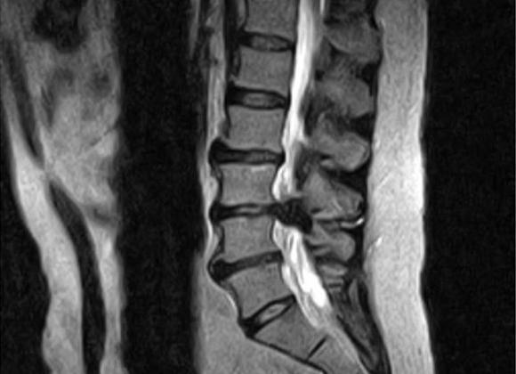 Мрт крестцово поясничного отдела что показывает
