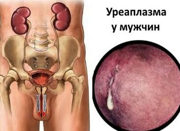 Мазок у мужчин на уреаплазму