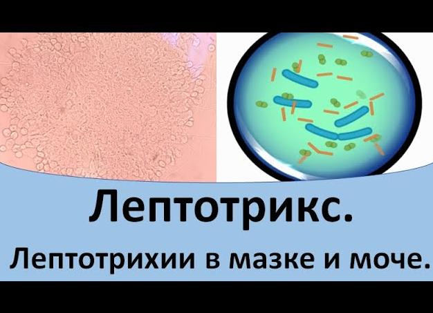 Лептотрихии в мазке что это