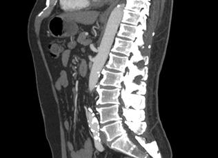 Кт снимок позвоночника