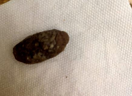 Кал с белым налетом