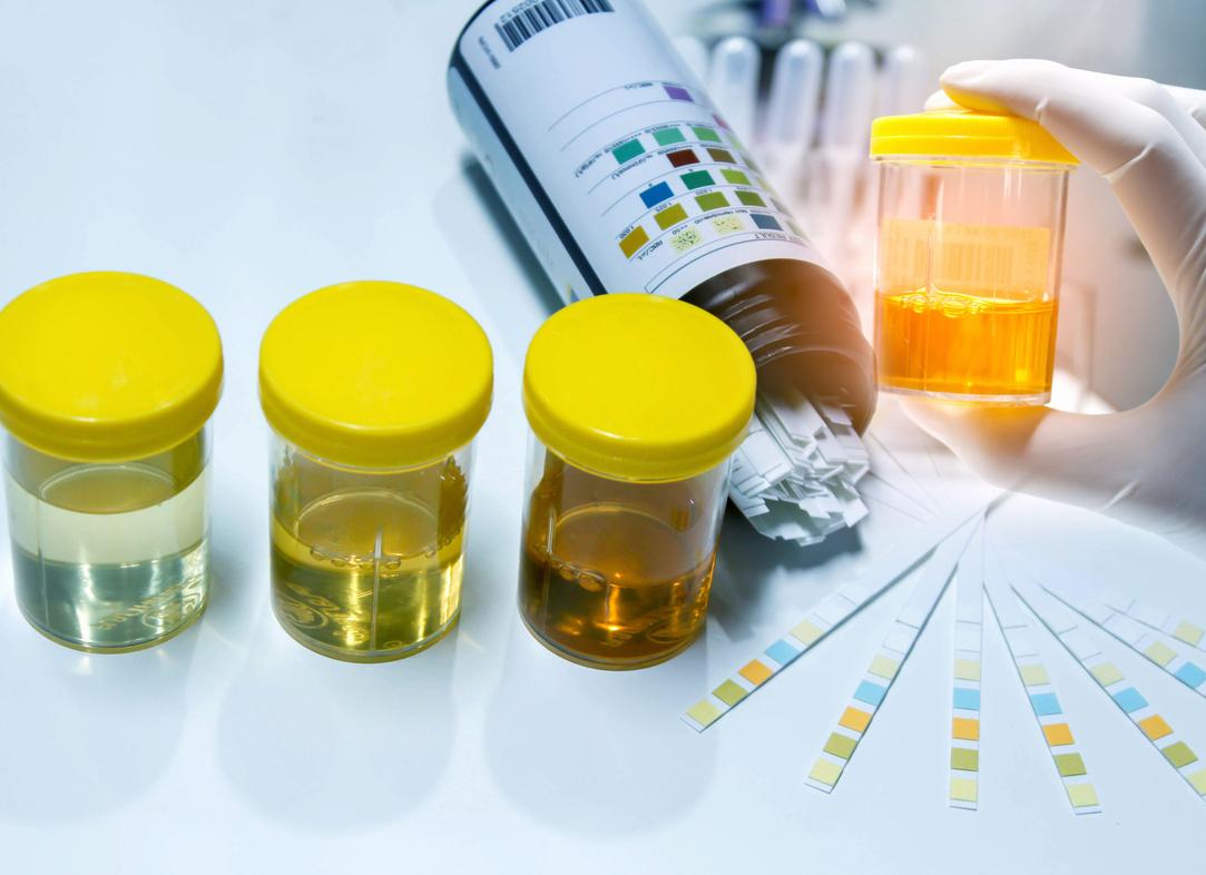 Как готовиться к анализу мочи