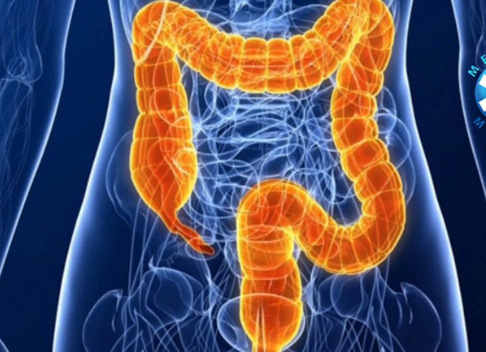 Ирригоскопия или колоноскопия что информативнее