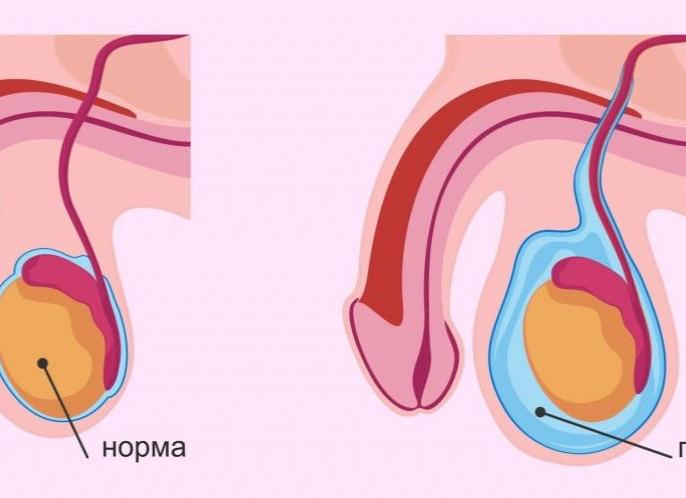 Гидроцеле яичка фото