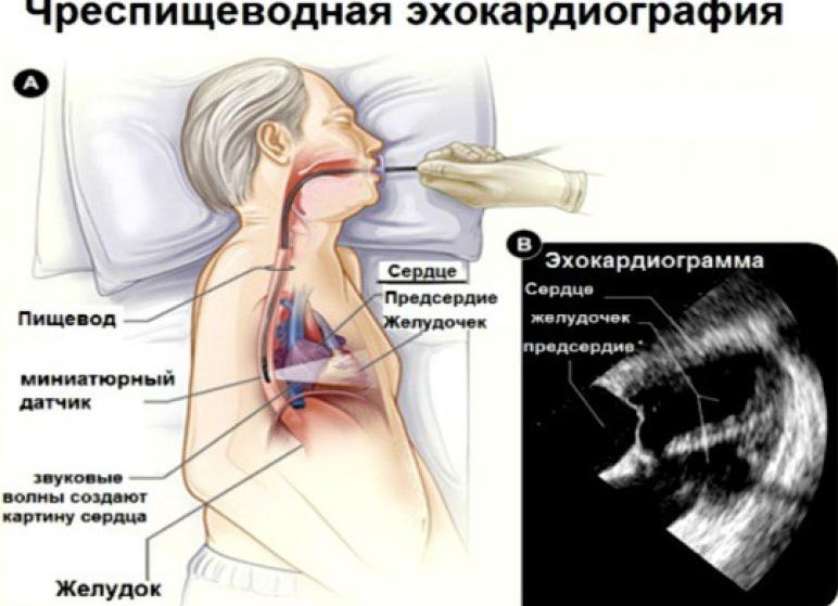 Эхо сердца что это такое как делают