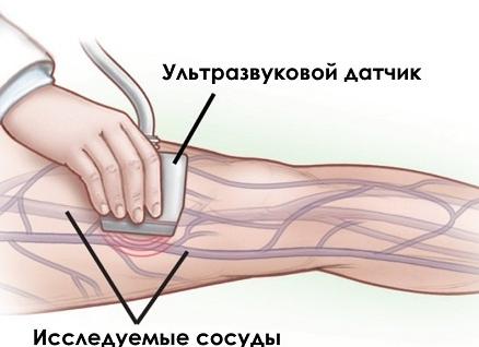 Дуплексное исследование сосудов