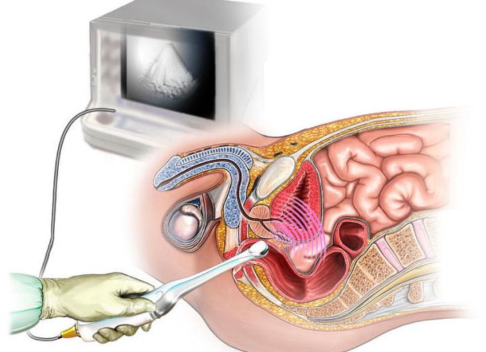 Допплерография сосудов малого таза у мужчин