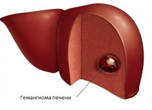 Диагностика образований в печени
