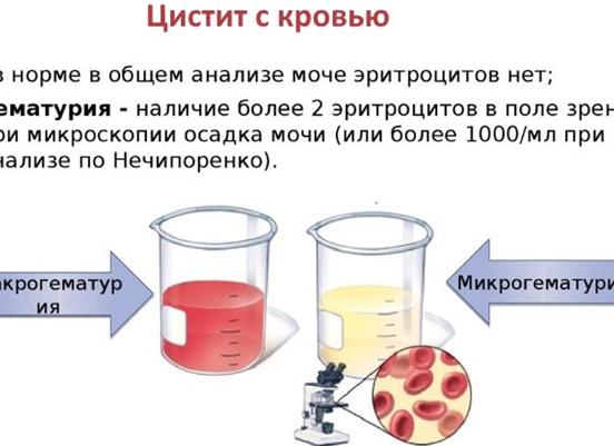Цистит может ли быть с кровью