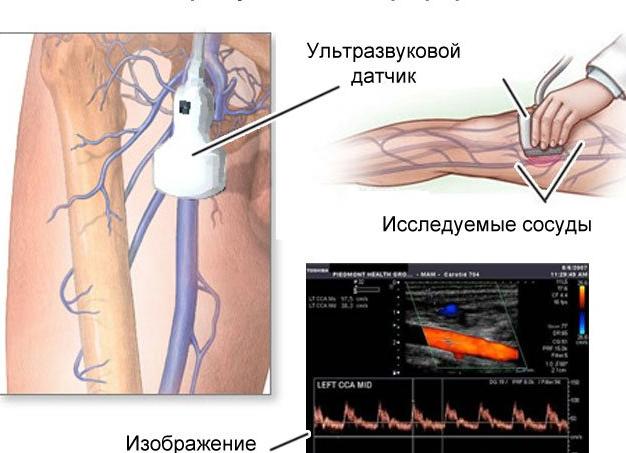 Что такое уздг вен нижних конечностей