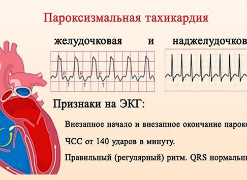 Что такое пароксизмальная тахикардия