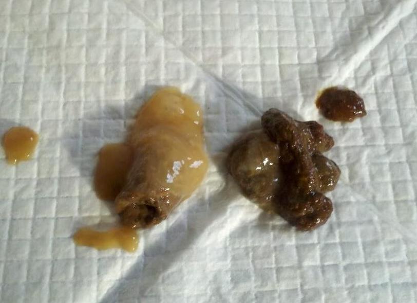 Белая слизь в кале у взрослого причины