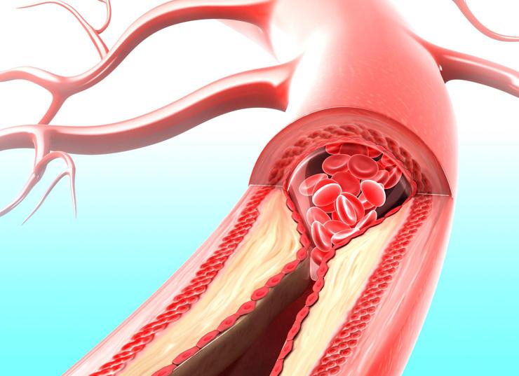 Ангиоспазм сосудов головного Ангиоспазм сосудов головного