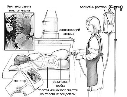 Как делают ирригоскопию
