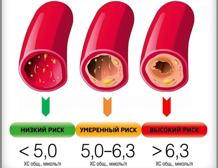 Когда повышен холестерин что делать