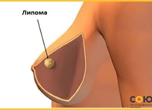На груди жировик