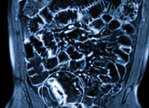 Мрт тонкого кишечника что показывает