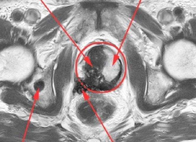 Мрт простаты подготовка к исследованию